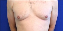 Male Breast Reduction Before Photo by Munique Maia, MD; Tysons Corner, VA - Case 48992