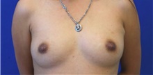 Breast Reconstruction After Photo by Munique Maia, MD; Tysons Corner, VA - Case 48993