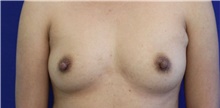 Breast Reconstruction Before Photo by Munique Maia, MD; Tysons Corner, VA - Case 48993