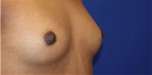 Breast Reconstruction After Photo by Munique Maia, MD; Tysons Corner, VA - Case 48994