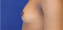 Breast Reconstruction After Photo by Munique Maia, MD; Tysons Corner, VA - Case 48994