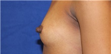 Breast Reconstruction Before Photo by Munique Maia, MD; Tysons Corner, VA - Case 48994