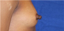Breast Reconstruction Before Photo by Munique Maia, MD; Tysons Corner, VA - Case 48994
