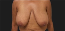 Breast Reduction Before Photo by Munique Maia, MD; Tysons Corner, VA - Case 48997