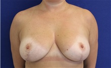 Breast Reduction After Photo by Munique Maia, MD; Tysons Corner, VA - Case 48999