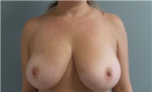 Breast Reduction Before Photo by Munique Maia, MD; Tysons Corner, VA - Case 48999