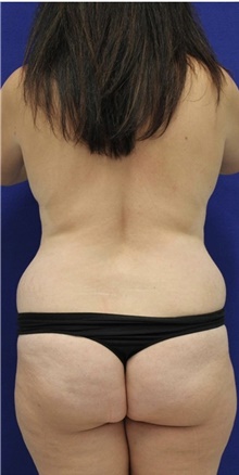 Liposuction Before Photo by Munique Maia, MD; Tysons Corner, VA - Case 49000