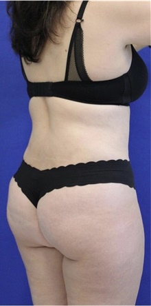 Liposuction After Photo by Munique Maia, MD; Tysons Corner, VA - Case 49000