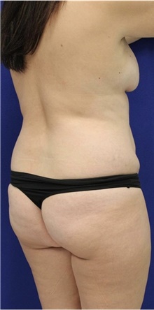 Liposuction Before Photo by Munique Maia, MD; Tysons Corner, VA - Case 49000