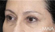 Eyelid Surgery After Photo by Munique Maia, MD; Tysons Corner, VA - Case 51306