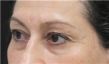 Eyelid Surgery Before Photo by Munique Maia, MD; Tysons Corner, VA - Case 51306