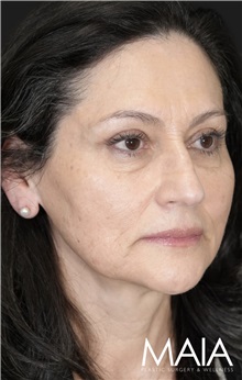 Eyelid Surgery After Photo by Munique Maia, MD; Tysons Corner, VA - Case 51306
