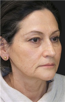 Eyelid Surgery Before Photo by Munique Maia, MD; Tysons Corner, VA - Case 51306