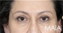 Eyelid Surgery After Photo by Munique Maia, MD; Tysons Corner, VA - Case 51306