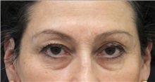 Eyelid Surgery Before Photo by Munique Maia, MD; Tysons Corner, VA - Case 51306