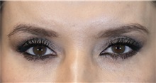 Eyelid Surgery After Photo by Munique Maia, MD; Tysons Corner, VA - Case 51304