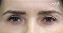 Eyelid Surgery Before Photo by Munique Maia, MD; Tysons Corner, VA - Case 51304