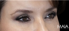 Eyelid Surgery After Photo by Munique Maia, MD; Tysons Corner, VA - Case 51304