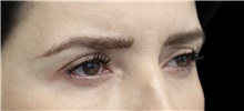 Eyelid Surgery Before Photo by Munique Maia, MD; Tysons Corner, VA - Case 51304