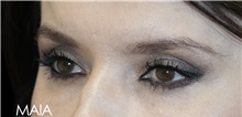 Eyelid Surgery After Photo by Munique Maia, MD; Tysons Corner, VA - Case 51304