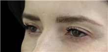 Eyelid Surgery Before Photo by Munique Maia, MD; Tysons Corner, VA - Case 51304