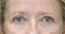 Eyelid Surgery After Photo by Munique Maia, MD; Tysons Corner, VA - Case 51308