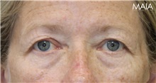 Eyelid Surgery Before Photo by Munique Maia, MD; Tysons Corner, VA - Case 51308