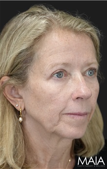 Eyelid Surgery After Photo by Munique Maia, MD; Tysons Corner, VA - Case 51308