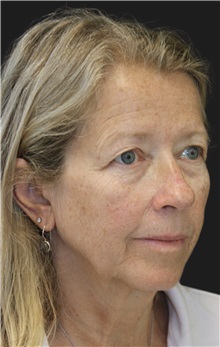 Eyelid Surgery Before Photo by Munique Maia, MD; Tysons Corner, VA - Case 51308
