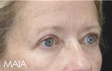Eyelid Surgery After Photo by Munique Maia, MD; Tysons Corner, VA - Case 51308