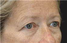 Eyelid Surgery Before Photo by Munique Maia, MD; Tysons Corner, VA - Case 51308