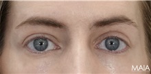 Eyelid Surgery After Photo by Munique Maia, MD; Tysons Corner, VA - Case 51305
