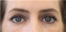 Eyelid Surgery Before Photo by Munique Maia, MD; Tysons Corner, VA - Case 51305
