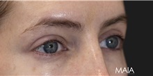 Eyelid Surgery After Photo by Munique Maia, MD; Tysons Corner, VA - Case 51305