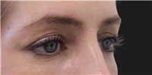 Eyelid Surgery Before Photo by Munique Maia, MD; Tysons Corner, VA - Case 51305