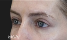 Eyelid Surgery After Photo by Munique Maia, MD; Tysons Corner, VA - Case 51305