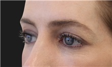 Eyelid Surgery Before Photo by Munique Maia, MD; Tysons Corner, VA - Case 51305