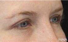 Eyelid Surgery After Photo by Munique Maia, MD; Tysons Corner, VA - Case 51315