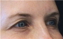 Eyelid Surgery Before Photo by Munique Maia, MD; Tysons Corner, VA - Case 51315