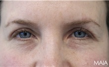 Eyelid Surgery After Photo by Munique Maia, MD; Tysons Corner, VA - Case 51315