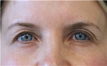 Eyelid Surgery Before Photo by Munique Maia, MD; Tysons Corner, VA - Case 51315