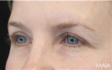Eyelid Surgery After Photo by Munique Maia, MD; Tysons Corner, VA - Case 51315