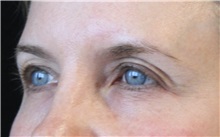 Eyelid Surgery Before Photo by Munique Maia, MD; Tysons Corner, VA - Case 51315
