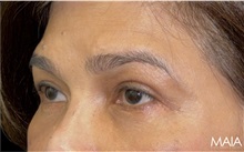Eyelid Surgery After Photo by Munique Maia, MD; Tysons Corner, VA - Case 51310