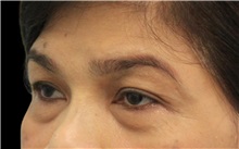 Eyelid Surgery Before Photo by Munique Maia, MD; Tysons Corner, VA - Case 51310