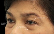 Eyelid Surgery Before Photo by Munique Maia, MD; Tysons Corner, VA - Case 51310