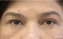 Eyelid Surgery After Photo by Munique Maia, MD; Tysons Corner, VA - Case 51310