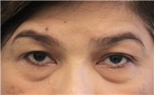 Eyelid Surgery Before Photo by Munique Maia, MD; Tysons Corner, VA - Case 51310