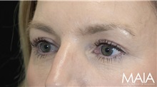 Eyelid Surgery After Photo by Munique Maia, MD; Tysons Corner, VA - Case 51309
