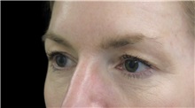 Eyelid Surgery Before Photo by Munique Maia, MD; Tysons Corner, VA - Case 51309